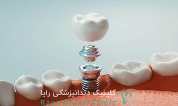 هزینه ایمپلنت فوری