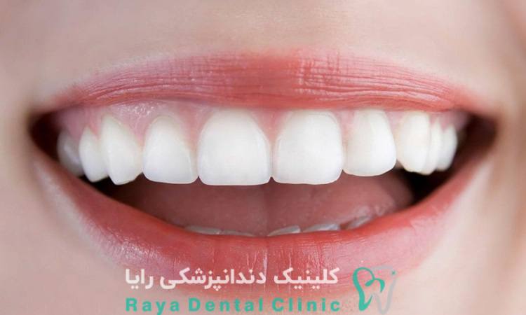 لمینت بدون تراش