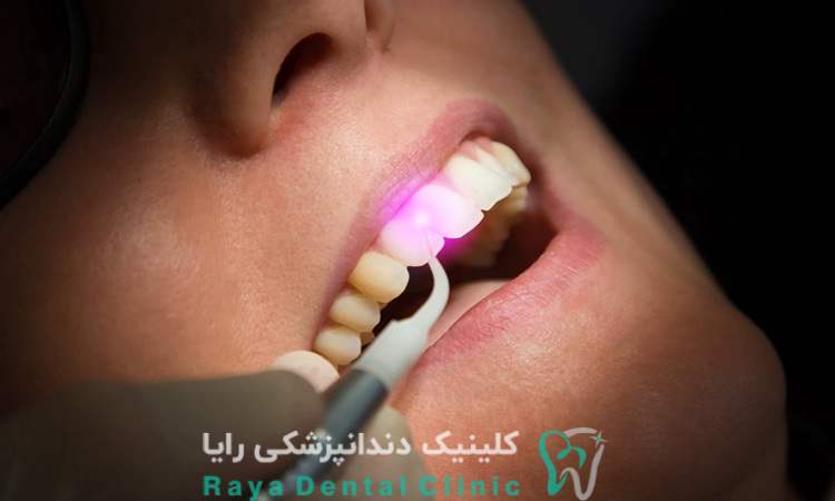 ریکاوری ایمپلنت دندان