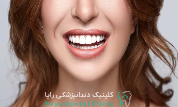  کاهش هزینه طراحی لبخند