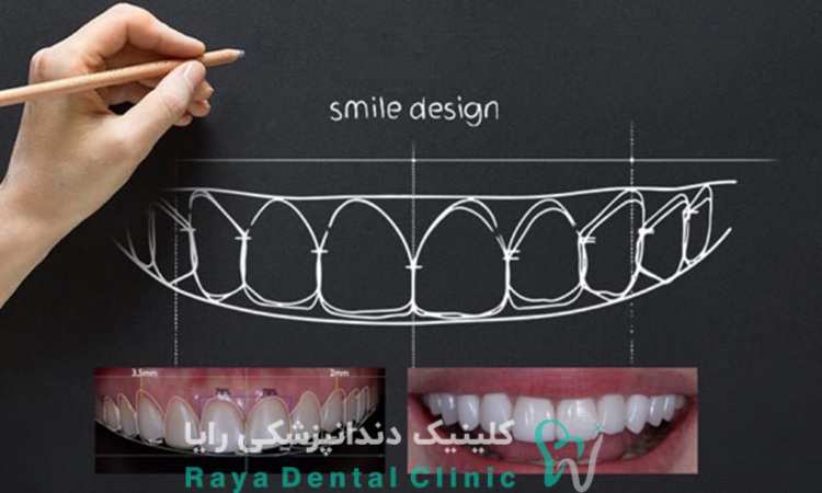 کیفیت طراحی لبخند