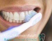 ماندگاری لمینیت دندان