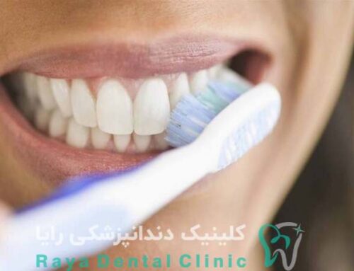 تاثیر بهداشت دهان بر ماندگاری لمینت دندان