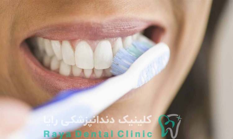 ماندگاری لمینیت دندان