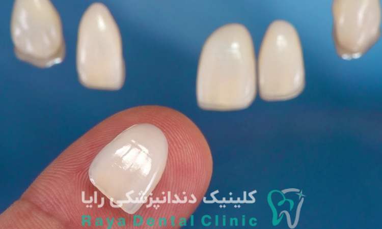کیفیت لمینیت دندان 