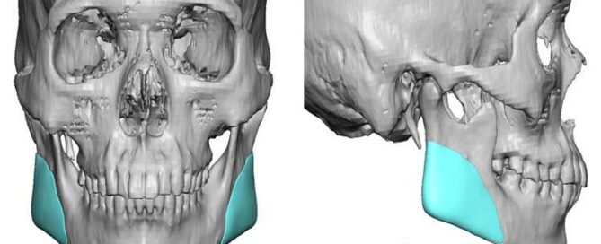 بهترین برند ایمپلنت