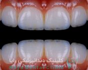 لمینیت فوری دندان