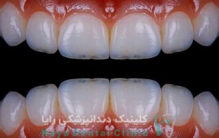 لمینیت فوری دندان