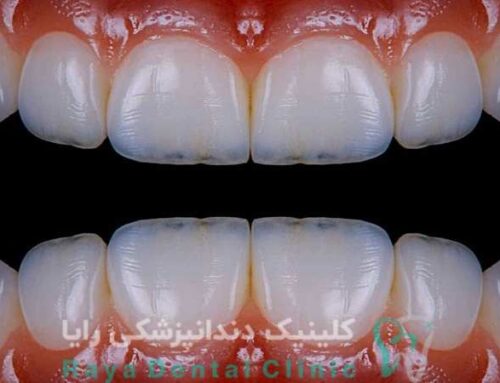 مزایا و معایب لمینیت فوری دندان؛ واقعیت یا تبلیغ؟