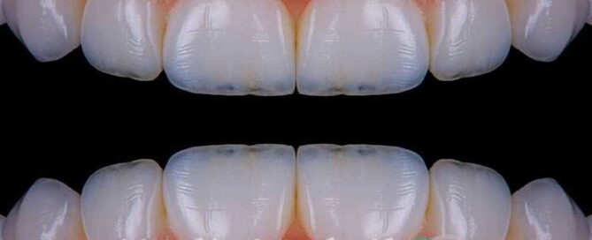 لمینیت فوری دندان