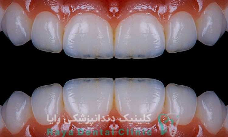 لمینیت فوری دندان