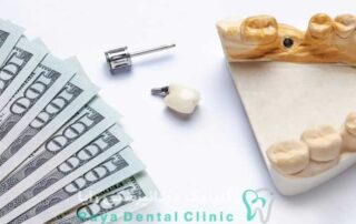 هزینه ایمپلنت دندان