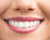 هزینه طراحی لبخند