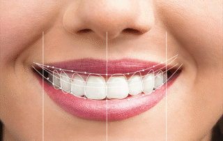 هزینه طراحی لبخند