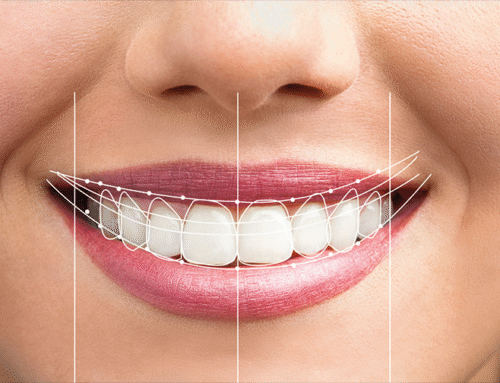 نکات کلیدی قبل از تصمیم‌ گیری برای هزینه طراحی لبخند