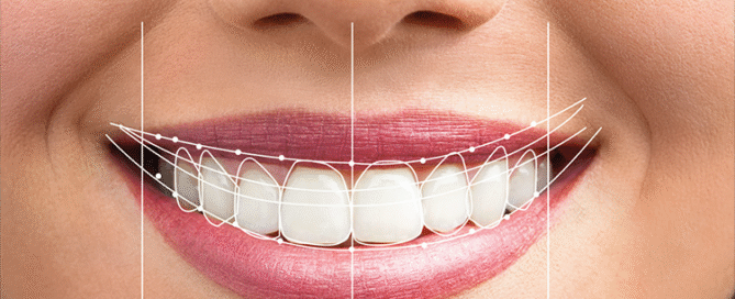 هزینه طراحی لبخند