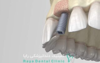 جوش خوردن ایمپلنت دندان