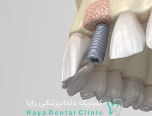 چقدر طول می‌ کشد تا ایمپلنت دندان خوب جوش بخورد؟