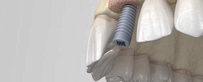 جوش خوردن ایمپلنت دندان