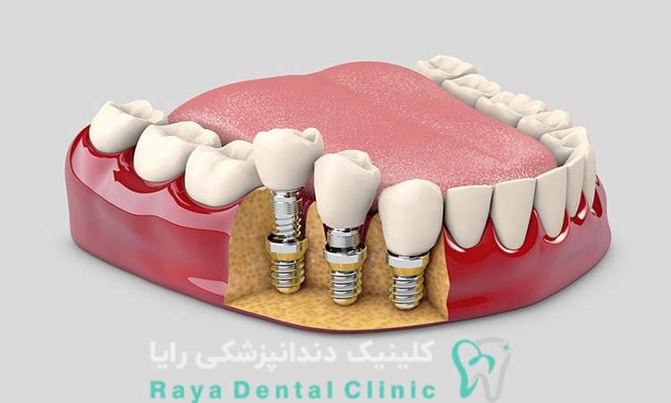 علائم جوش خوردن ایمپلنت