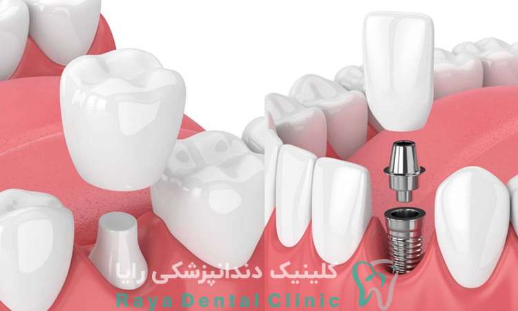 کاشت دندان با بی حسی