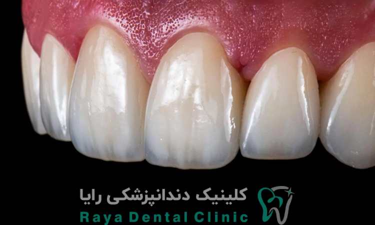 ونیر سرامیکی طبیعی چیست