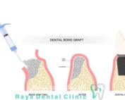 پیوند استخوان ایمپلنت