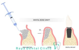 پیوند استخوان ایمپلنت