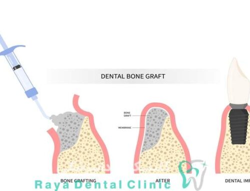 راهنمای مراقبت های بعد از پیوند استخوان ایمپلنت