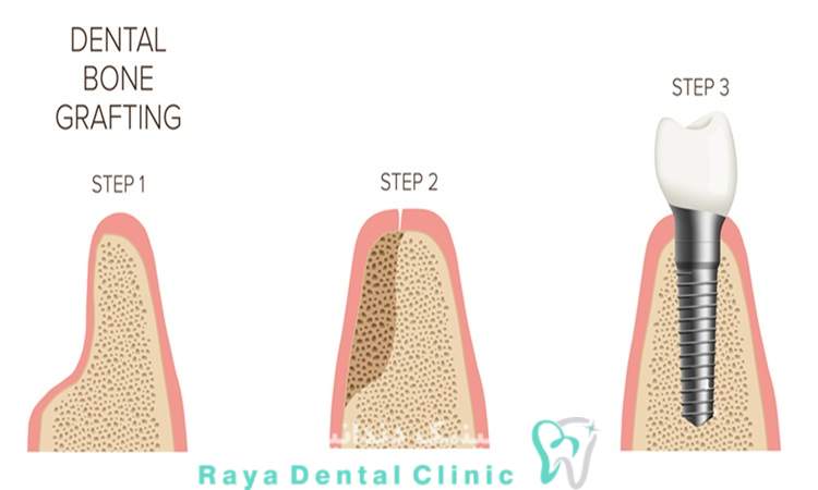 محدودیت های فیزیکی پیوند استخوان