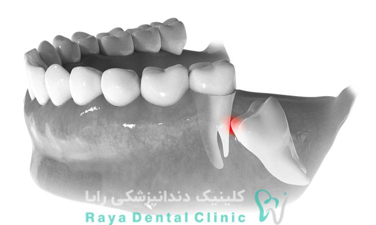 نکات قبل از جراحی دندان عقل
