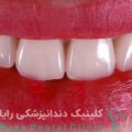 ماندگاری لمینیت دندان