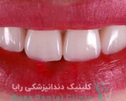 ماندگاری لمینیت دندان