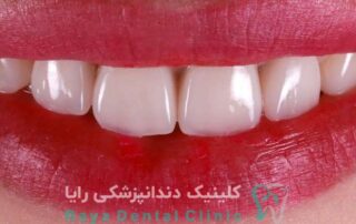 ماندگاری لمینیت دندان