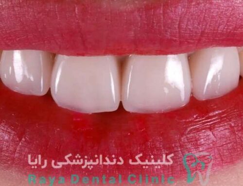 تاثیر طول عمر و ماندگاری لمینیت دندان در انتخاب نهایی