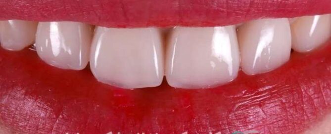 ماندگاری لمینیت دندان