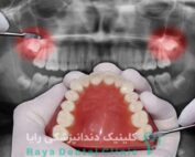 جراحی دندان عقل
