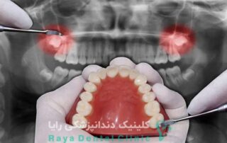 جراحی دندان عقل