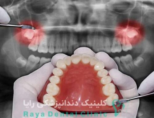آنچه باید قبل از جراحی دندان عقل بدانید؛ نکات مهم برای کاهش عوارض