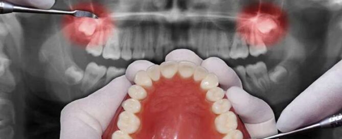 جراحی دندان عقل