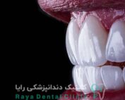 ونیر سرامیکی طبیعی