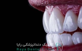 ونیر سرامیکی طبیعی