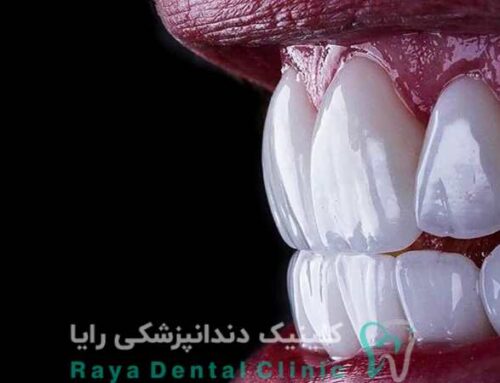 آیا ونیر سرامیکی طبیعی لکه پذیر است؟