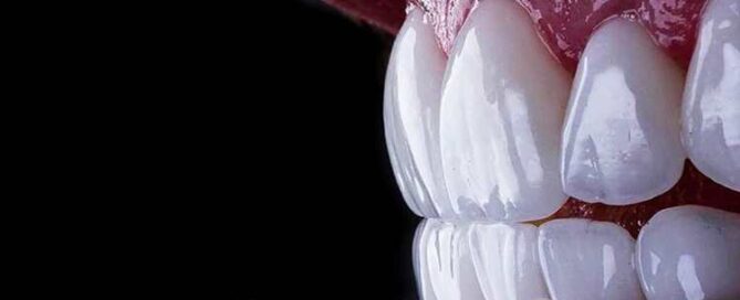 ونیر سرامیکی طبیعی