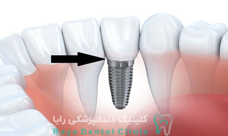 هزینه ایمپلنت دندان