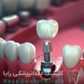 کاشت دندان بدون درد
