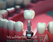 کاشت دندان بدون درد