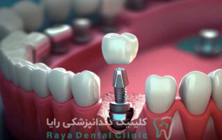 کاشت دندان بدون درد