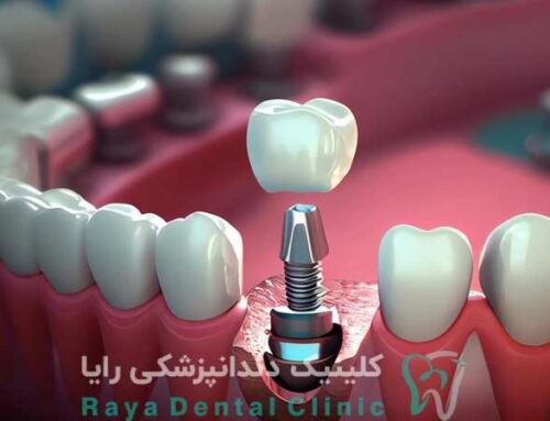 آیا امکان کاشت دندان بدون درد وجود دارد؟