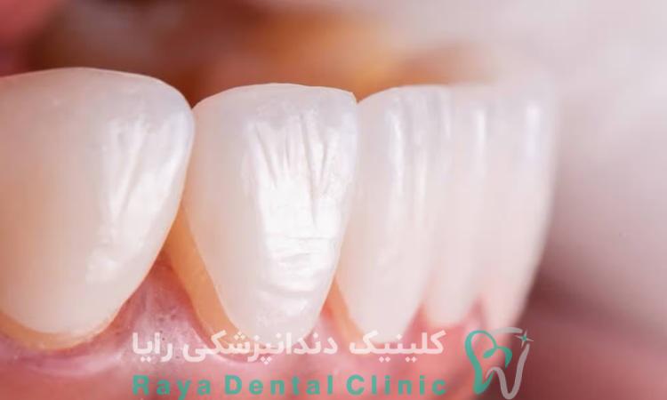 استحکام لمینیت دندان
